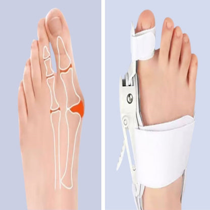 Starixa® Ayarlanabilir Ayak Baş Parmak Kemik Düzeltici - Halluks Valgus (Bunyon) Aparatı, Gece Gündüz Kullanıma Uygun Ayak Düzeltme Ateli